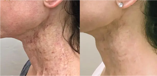 Neogen before and after result