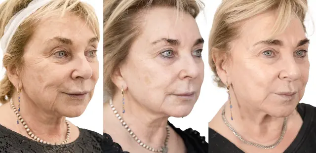 Neogen before and after result
