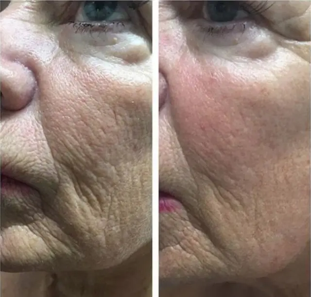 Neogen before and after result