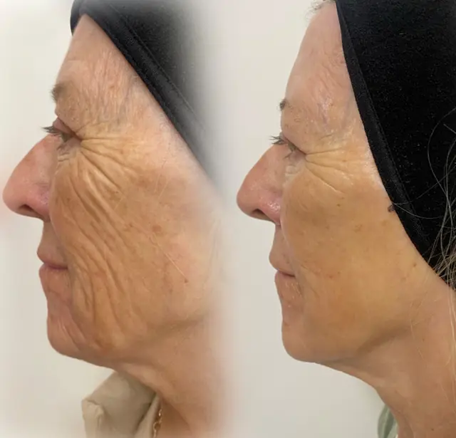 Neogen before and after result