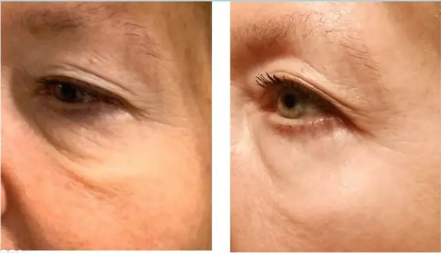 Neogen before and after result