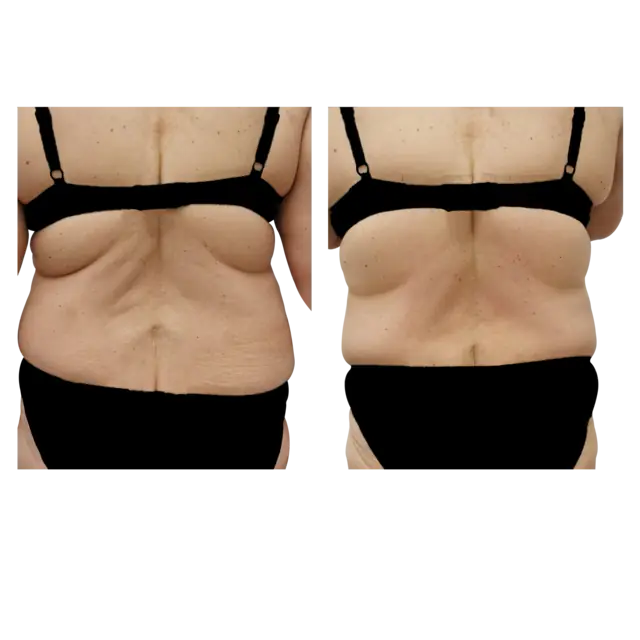 T-Shape 2 result — After 10 treatments