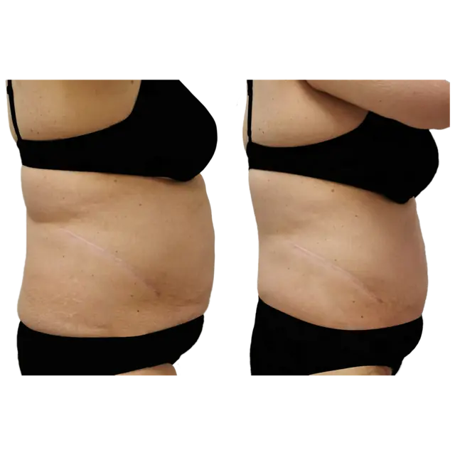 T-Shape 2 result — After 10 treatments 2