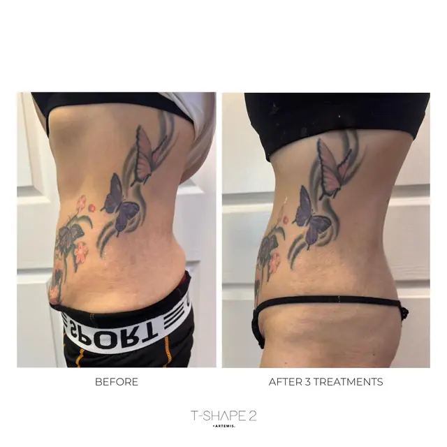 T-Shape 2 result — After 3 treatments (2)