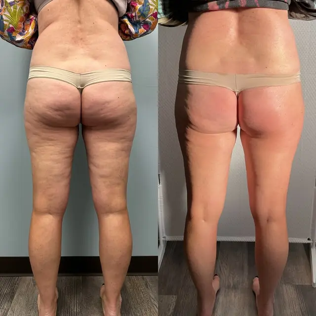 T-Shape 2 result — After 3 treatments (back)