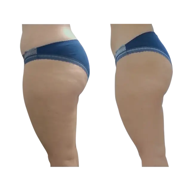T-Shape 2 result — After 3 treatments (side 2)