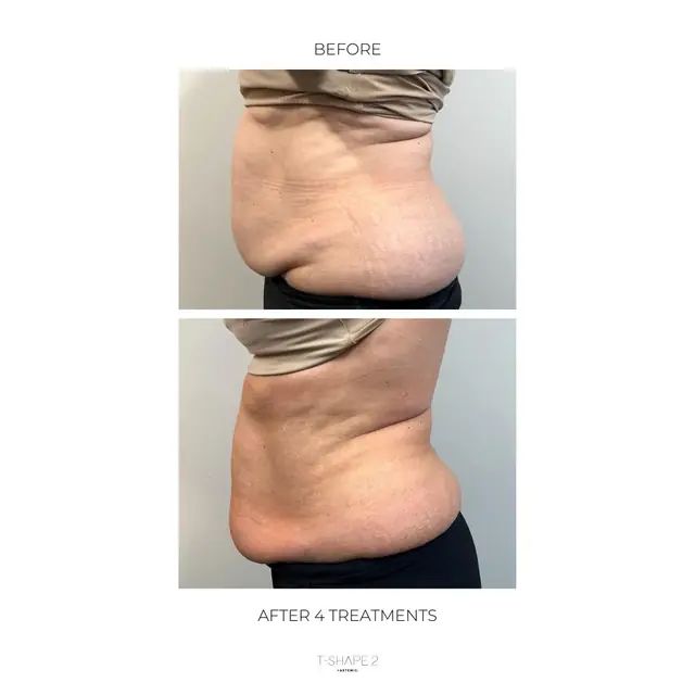 T-Shape 2 result — After 4 treatments copy