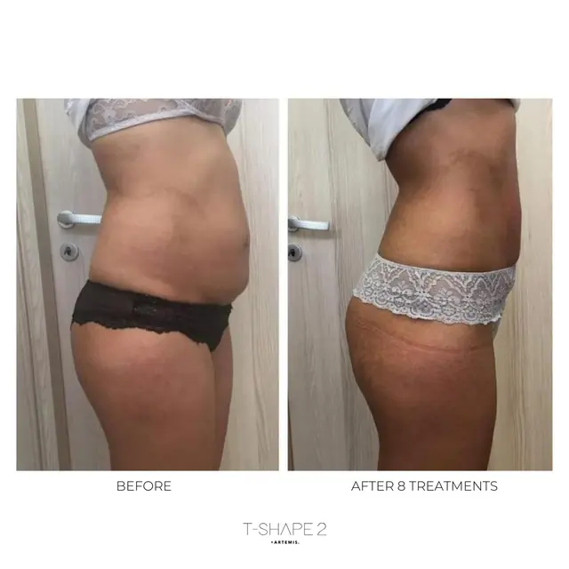 T-Shape 2 result — After 8 treatments