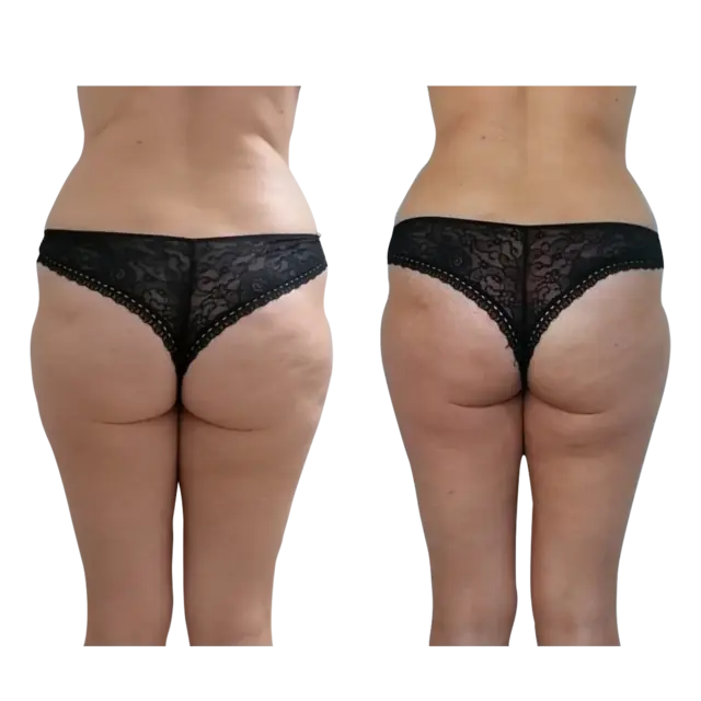T-Shape 2 result — After 8 treatments