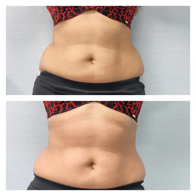 T-Shape 2 result — T shape2 after 1 front