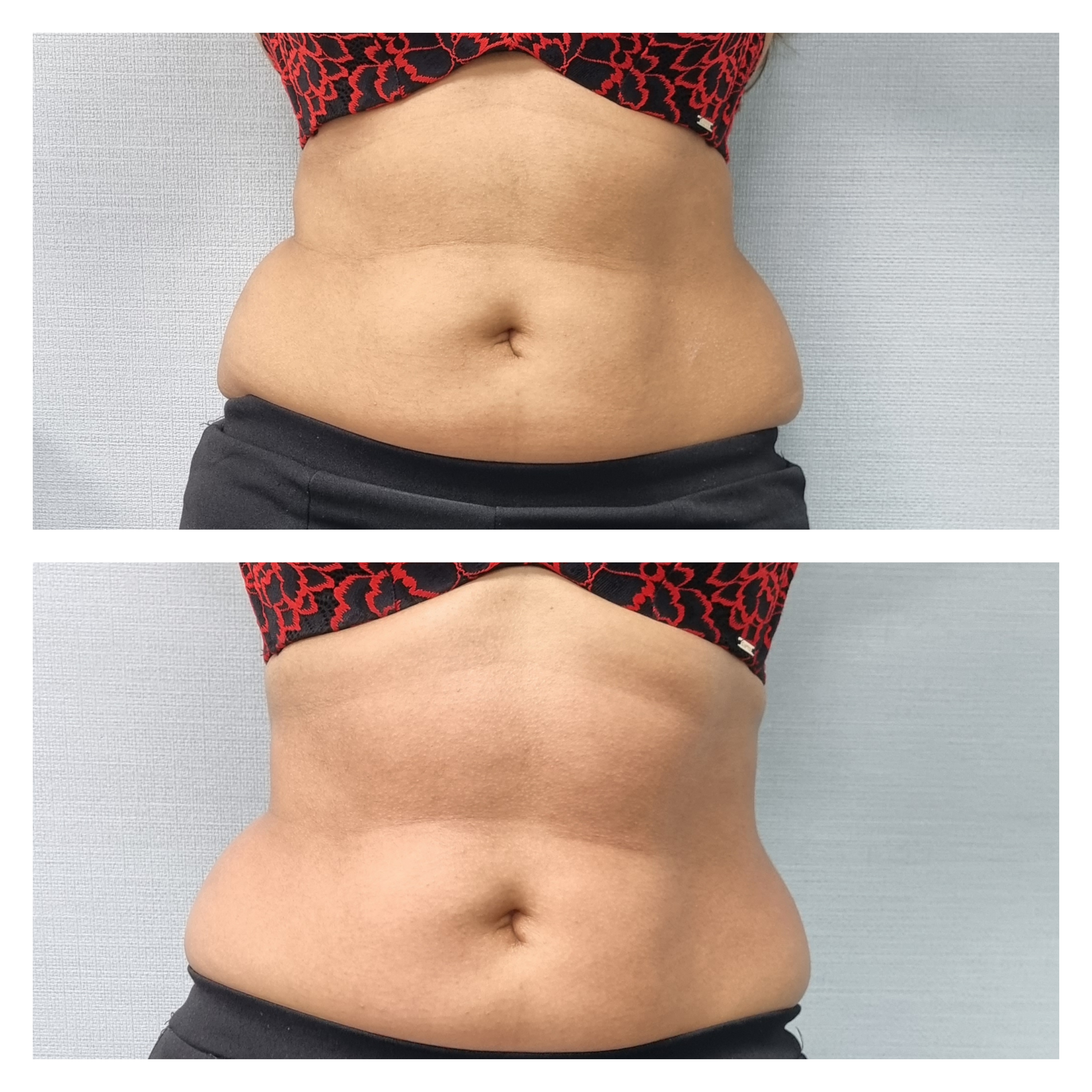 T-Shape 2 result — T shape2 after 1 front